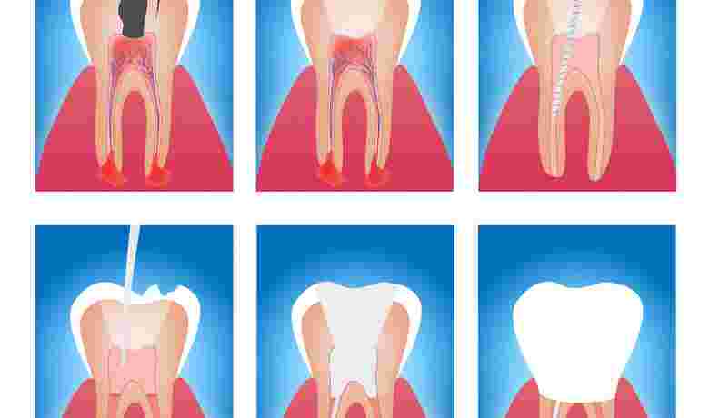 Endodoncia_23