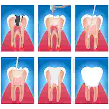 Endodoncia