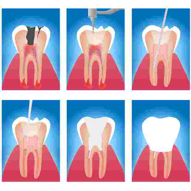 Endodoncia